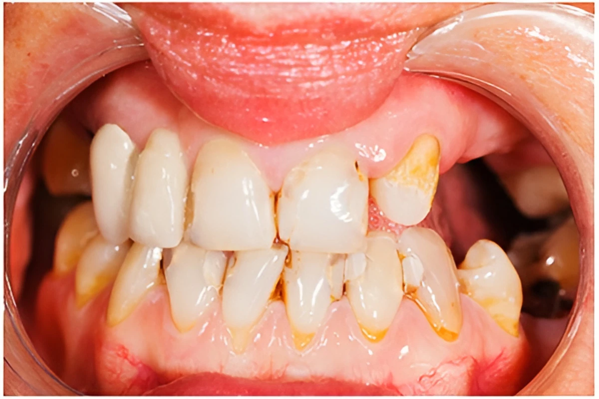 反対咬合（はんたいこうごう）：うけ口