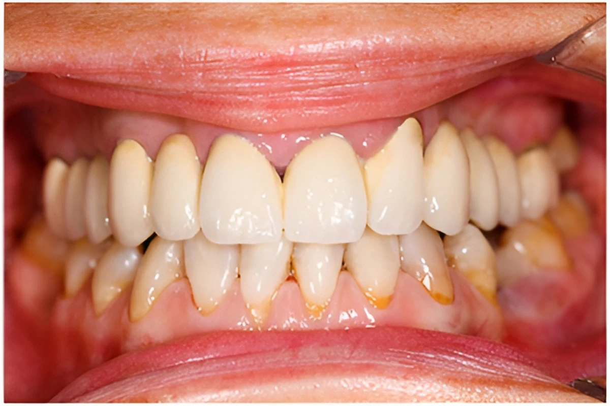 反対咬合（はんたいこうごう）：うけ口