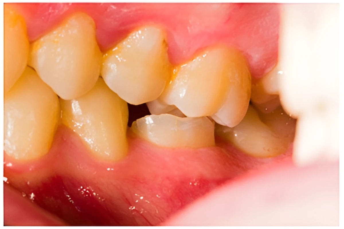 開咬（かいこう）