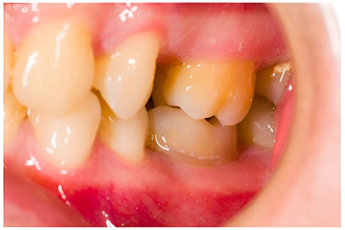 開咬（かいこう）