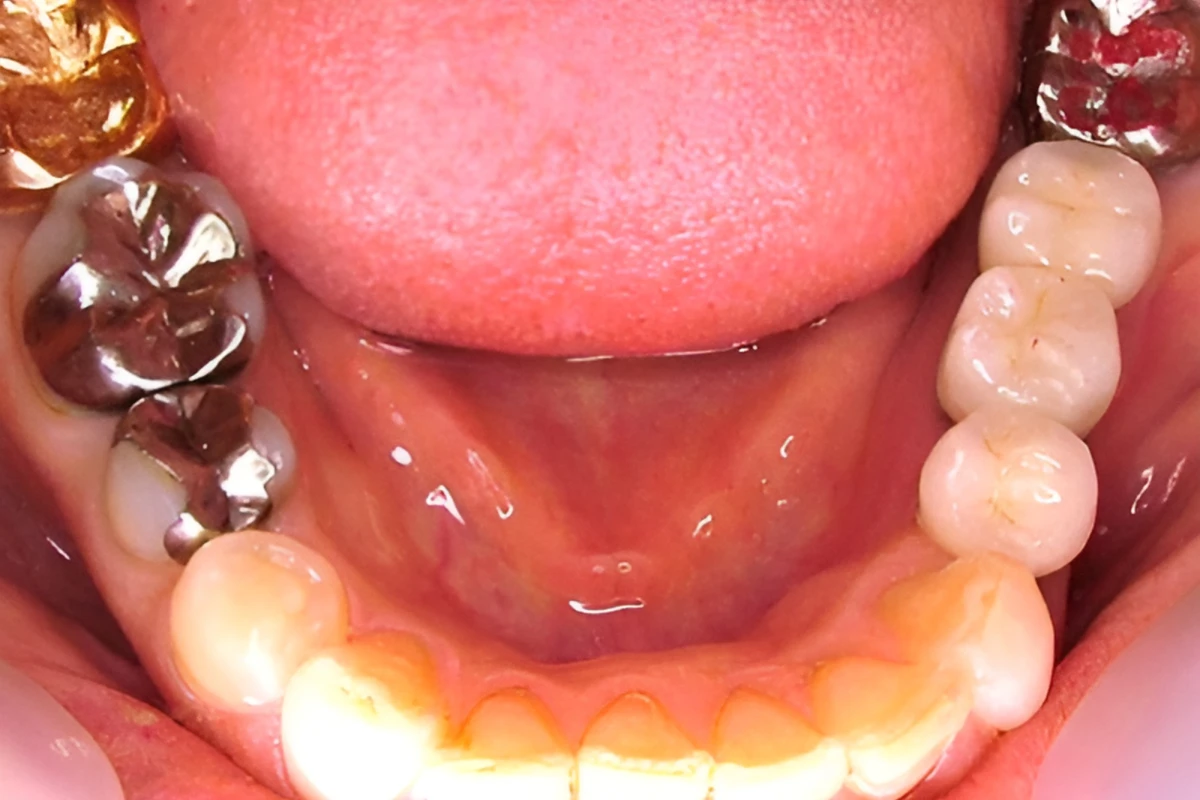 （症例　A）　インプラント術前