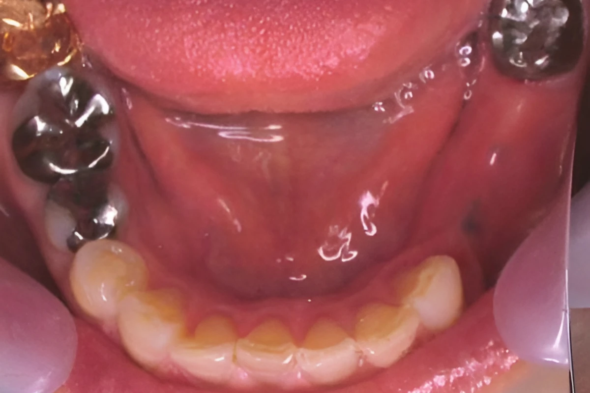 （症例　B）　インプラント術前