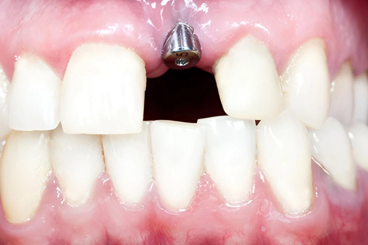 （症例　A）　インプラント術後