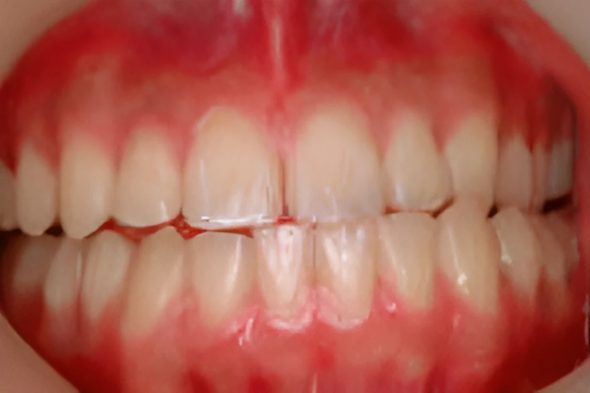 ホームブリーチング